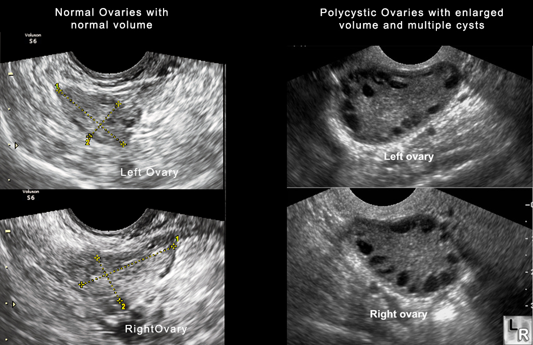 PCOS 1 PCOS 1