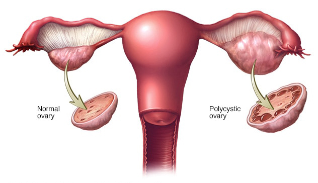 PCOS 2 PCOS 2